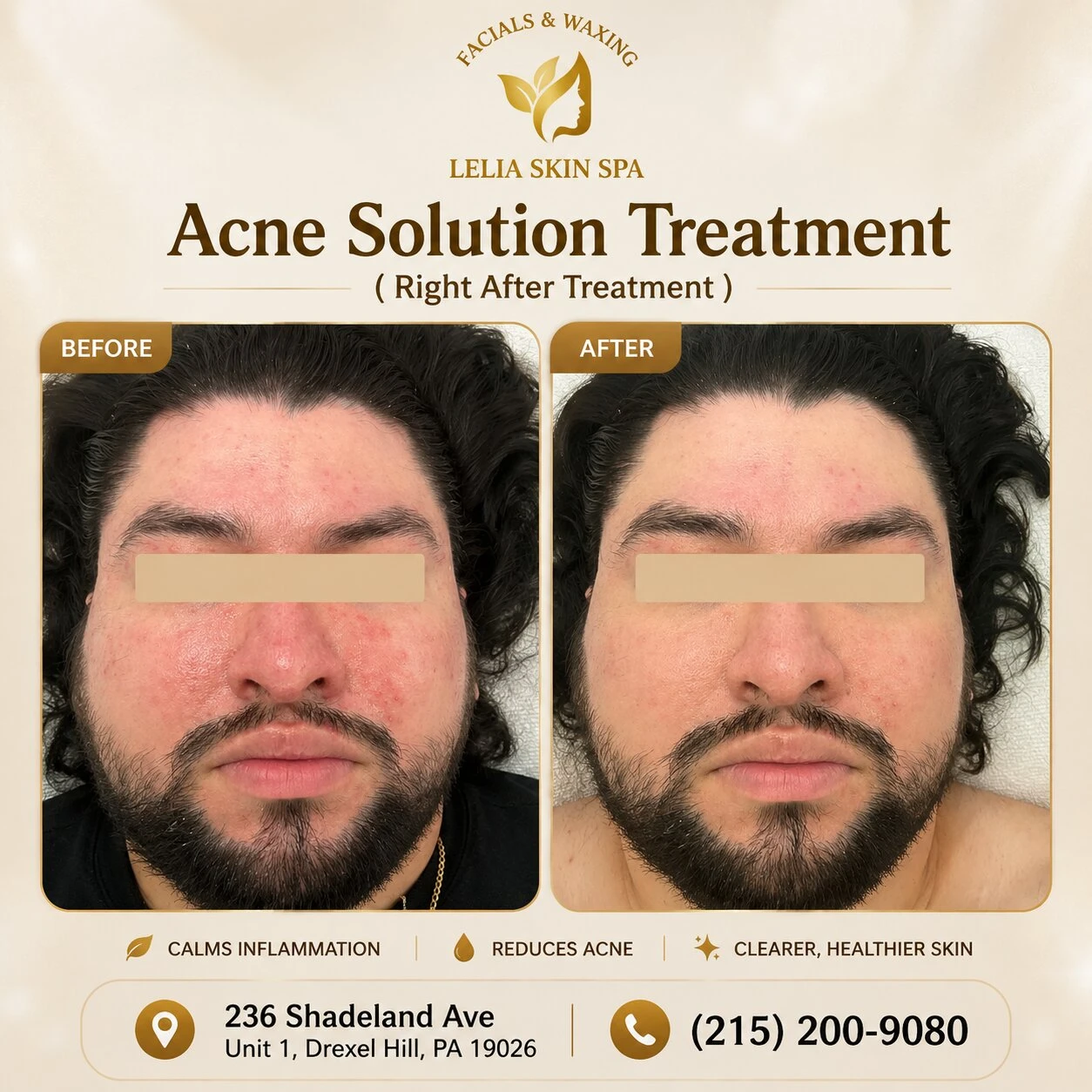 acnes solution